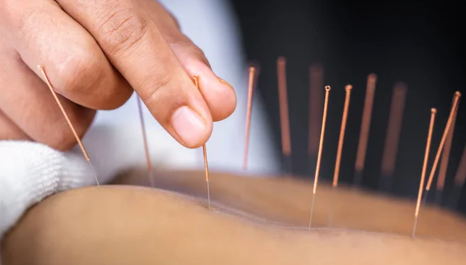 Acupunctrice